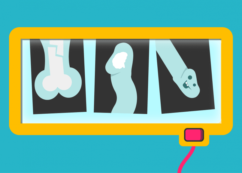 En illustration på röntgenbilder på penis olika delar med en pung med brutet ben, en penis med en hjärna och en glas snopp